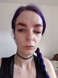 Mum 'left looking like Quasimodo after life-threatening allergic reaction  to eyebrow tint'