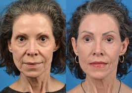 Image result for Laser Skin Procedure