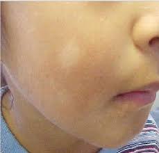 What Are Those White Spots On My Child S Face White Skin Spots White Skin Patches Brown Spots On Face