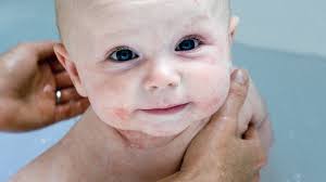 The bath may also be cleaned with an ordinary bath cleaner, but be careful to rinse it thoroughly. Bathe Daily Advice For Eczema Children Bbc News
