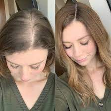 Chez la femme, cette alopécie androgénétique peut être liée à des . Epingle Sur Alopecie Androgenetique