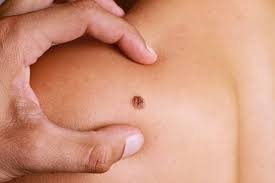 Image result for Moles on the chest