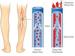 Compression Socks For Long Flights Immediate Relief From Dvt