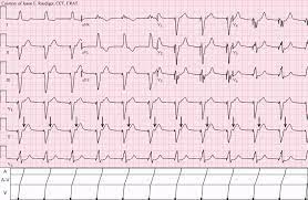 Check the pacing lead (the lead which sends information from the heart to the pacemaker) with an electrocardiogram (ecg) at your doctor's office. Pacemaker Syndrome Wikipedia