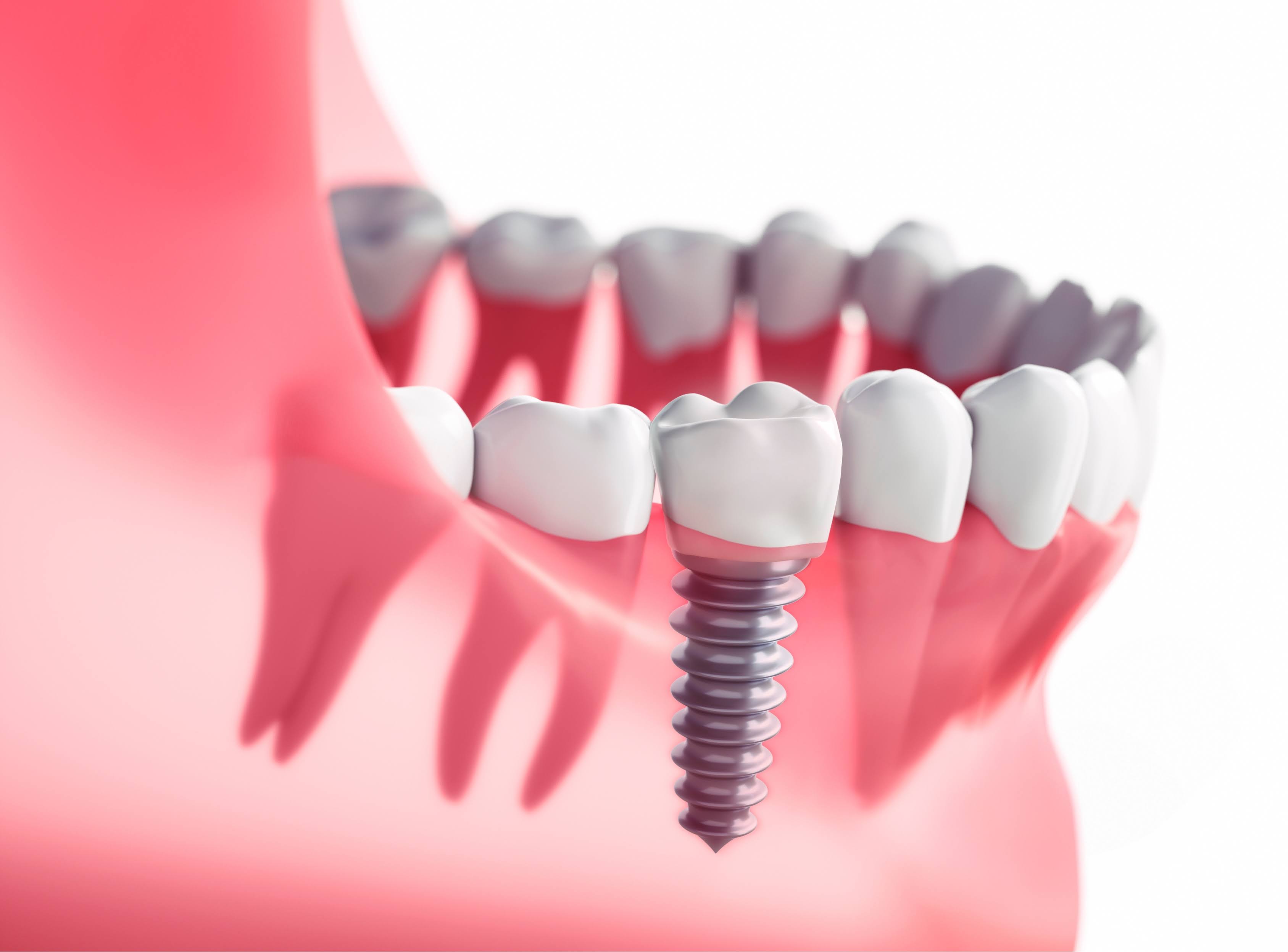 Dental Implants product image