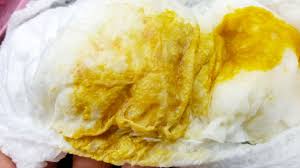 Image result for yellow stool human poop