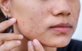 Image result for acne face