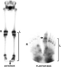 Image result for Osteomyelitis Bone Scan