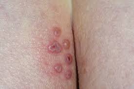 Image result for genital herpes