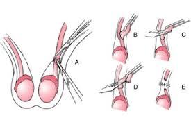 Vasectomy is a surgical procedure for male sterilization or permanent contraception. Vasectomia Centro Especializado En Urologia