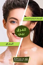 البهاق يحدث نتيجة تحطم الخلايا الملونة المنتجة للميلانين المسؤول عن إكساب البشرة لونها ويكون نتيجة لخلل في الغدة النخامي Incoming Call Screenshot Incoming Call