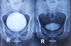 Image result for Retrograde Urethrogram