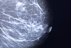 A mammogram image has a black background and shows the breast in variations of gray and white. Breast Cancer Awareness Symptoms Diagnosis And Treatment