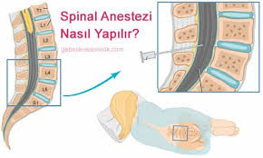 Spinal Anestezi Nedir 2020 Ogrenme Anne