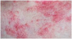 Incubatia are o durata de circa o saptamana. Mancarimea De Piele Prurit Cauze Tipuri Diagnostic Tratament Poze