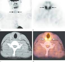 Maybe you would like to learn more about one of these? Mip Fdg Pet Image A And Transverse Fdg Pet B Ct C And Fused Download Scientific Diagram