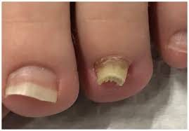 Image result for Onycholysis feet
