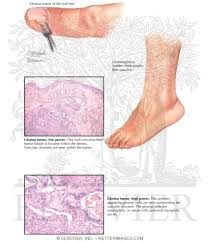 Image result for Glomus tumor