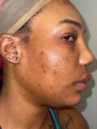 How to get rid of acne scarring due to picking?