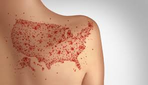 Pennsylvania reports fourth measles death amid feud with RFK Jr.