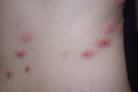 Image result for flea bites