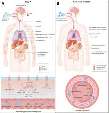 Image result for Multisystem Inflammatory Syndrome