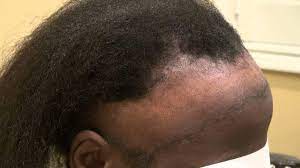 Though not as common as with men, a receding hairline in women is possible. What To Do About Your Receding Hairline Ibiene Magazine