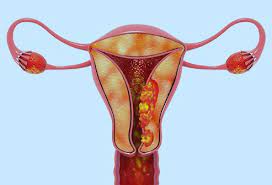 Looking for cancer cover that supports you every step of the way? Uterine Cancer Diagnosis Stages Treatment Causes