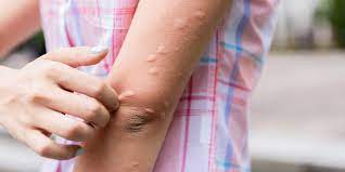 Hives 5 Causes You Wouldn T Expect Health Com