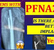 Problems with PFN: is TFNA a solution for trochanteric fractures in old