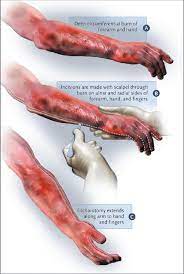 In this case, two transverse incisions, connecting the axial chest wall incisions, should be used. Method Of Performing An Escharotomy Download Scientific Diagram