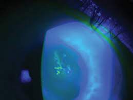 A comprehensive hsv keratitis treatment guideline authored by drs. Herpes Simplex Keratitis Managing The Masquerader