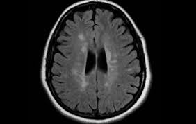 We will discuss the following subjects: Lesiones Cerebrales De La Esclerosis Multiple Imagenes Y Pronostico