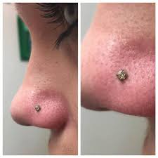 When it comes to doing a piercing near your mouth (such as tongue or lip), near your eye, or at the top of your ear, it is best to see a professional. Swollen Nose Piercing Causes Treatment Authoritytattoo