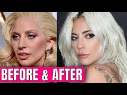 Lady Gaga Plastic Surgery 2020 Youtube Lady Gaga Plastic Surgery Lady Gaga Surgery Plastic Surgery
