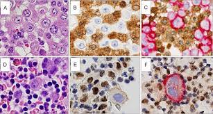 Hida t, hamasaki m, matsumoto s, sato a, tsujimura t, kawahara k, iwasaki a, okamoto t, oda y, honda h, et al. A Combination Of Mtap And Bap1 Immunohistochemistry In Pleural Effusion Cytology For The Diagnosis Of Mesothelioma Kinoshita 2018 Cancer Cytopathology Wiley Online Library