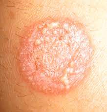 Malle aux tresor xp facilement son personnage astuce ! Mycose Causes Symptomes Traitement Teleconsultation Dermatologue