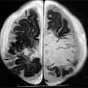It is estimated to affect at least 1 in 500,000 individuals per year, and some studies suggest an incidence rate of 5.9 cases per 100,000 live births. Https Encrypted Tbn0 Gstatic Com Images Q Tbn And9gcqruxoj Cah4w2doch2j6e9wjyrmjyfco1gvg1lzx8x Hbh2uvo Usqp Cau