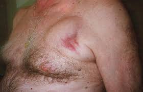 Please review pacer/icd workflow diagram below for overview of how these cases should be handled. How To Treat And Identify Device Infections Heart Rhythm