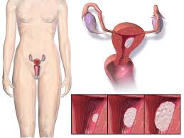 Endometrial cancer usually affects women after menopause. Endometrial Cancer Wikipedia