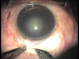 Fish Hook Technique Small Incision Cataract Surgery Youtube
