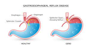 Maybe you would like to learn more about one of these? Penyakit Gerd Gejala Penyebab Pengobatan Klikdokter Com
