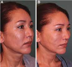 Pdo thread mid face lift. Before Thread Lift A And 6 Months After Thread Lift B With Download Scientific Diagram
