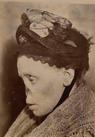 How syphilis changed the face of medical research. Lindsey Fitzharris Auf Twitter Before Penicillin Syphilis Was Incurable Victims Often Developed Saddle Nose A Deformity Where The Bridge Of The Nose Caves Into The Face It Was So Common No Nose Clubs