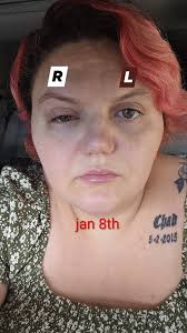 Hello. Does anyone get facial head pain with Retinal Vasculitis and  Uveitis? Two types of discomfort pain First It's like someone has punched  me