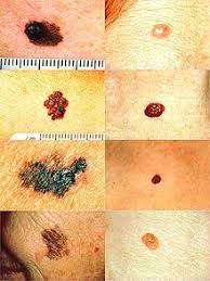 Melanomas typically occur in the skin but may rarely occur in the mouth, intestines or eye (uveal melanoma). Malignes Melanom Wikipedia
