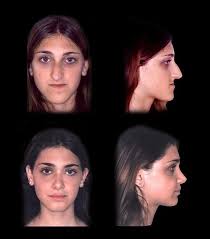Otherwise known as orthognathic surgery with a le fort 3 osteotomy on my upper jaw and a bilateral sagittal since i wrote my first post in the throes of jaw surgery recovery, i have received so many messages from people checking in on how i'm doing and. The Difference Jaw Surgery And Rhinoplasty Made On This Woman Medizzy