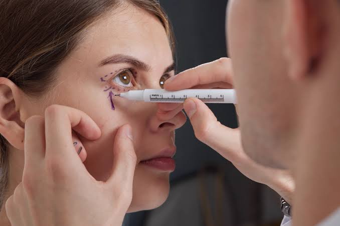 Eyelid Surgery | Estecenter