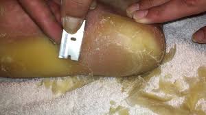 But dead skin from the foot is visibly black and painful. This Man S Callus Shaving Video Went Viral Here S What A Podiatrist Thinks Health Com