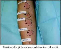 I sintomi sono dolorosi e generalmente scompaiono da. Allergie Ed Intolleranze Alimentari Roma Gastroenterologo Dott Prof Antonio Iannetti